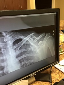 does_my_collarbone_need_surgery