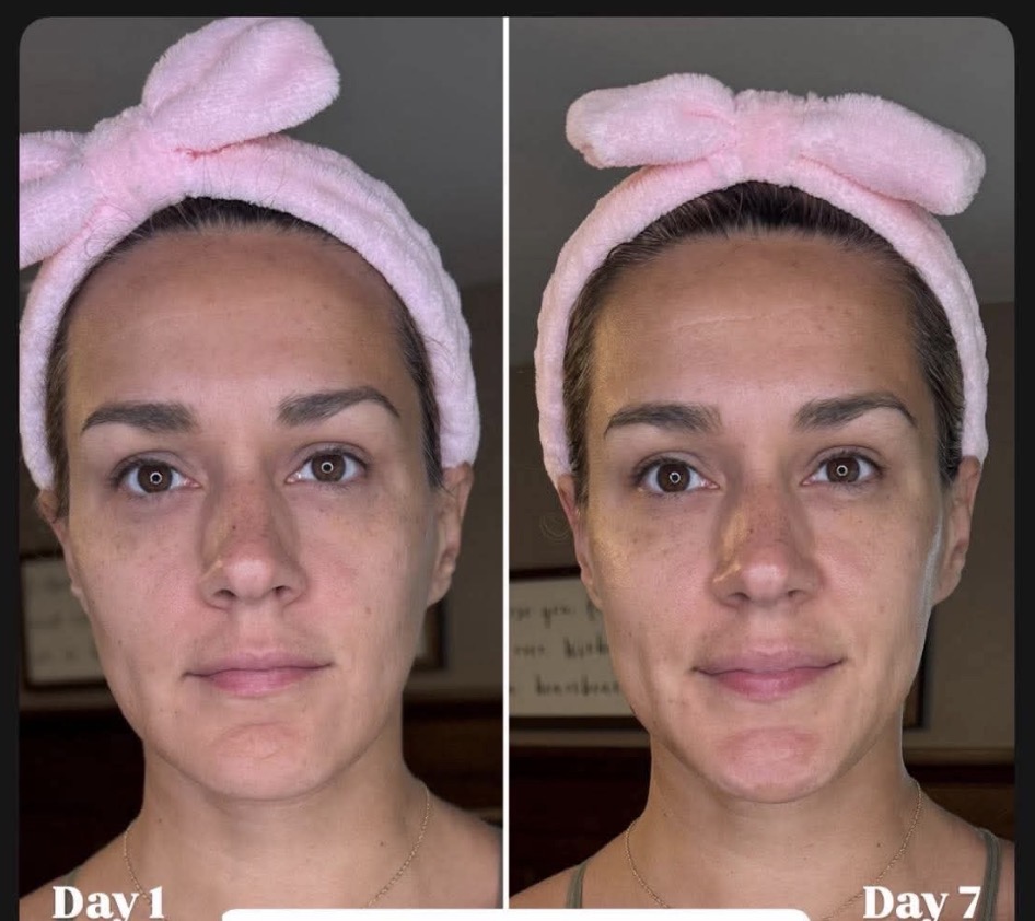 The spa method renewed peptide one week results for my friend Erica who is a part of the beauty insider